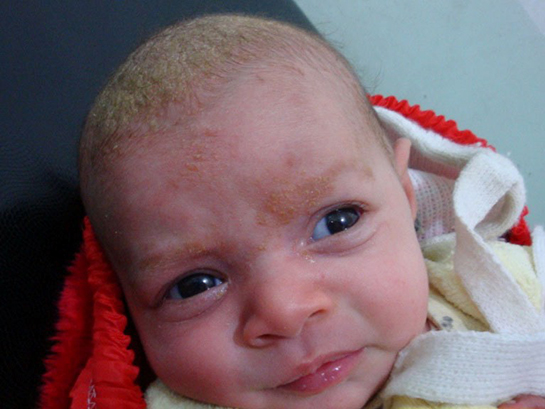 Bebeklerde Seboreik Dermatit Belirtileri ve Tedavisi Bebeklerde Seboreik Dermatit Belirtileri ve Tedavisi